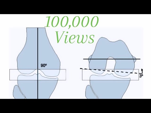 Total Knee Replacement Step by Step