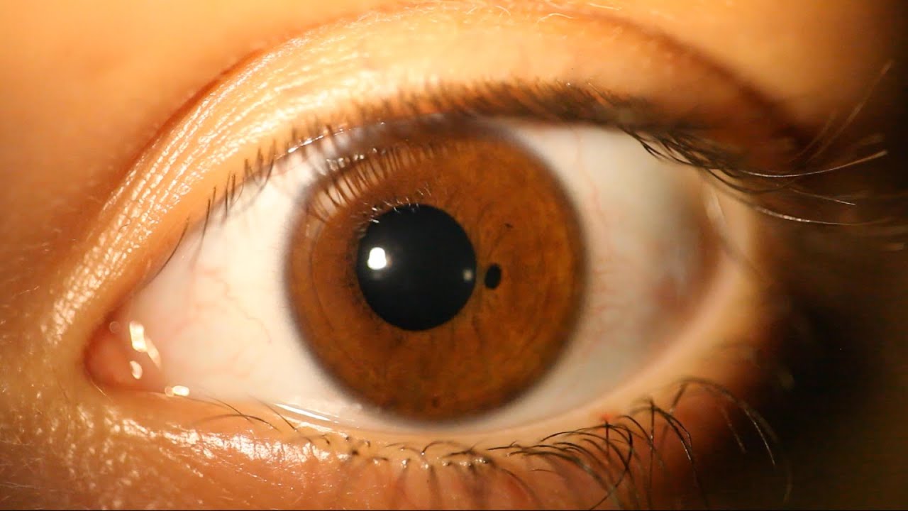 Extra Pupil in a 9-Year-Old Girl