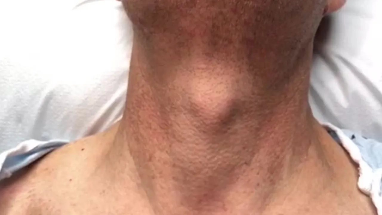 Jugular Venous Pulsations in Constrictive Pericarditis cover