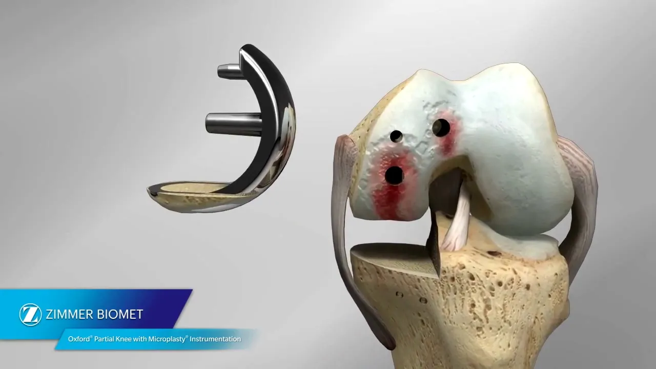 Oxford® Partial Knee Microplasty® Instrumentation Animation